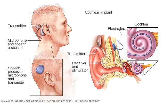 cochlear implant pictures