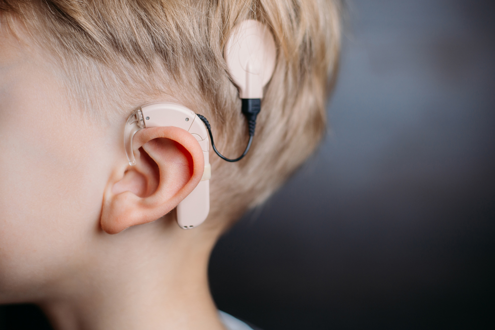 cochlear implants in Aligarh