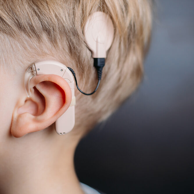 cochlear implants in Aligarh